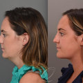 Enhance Your Features With Cleopatra Contour Plastic Surgery