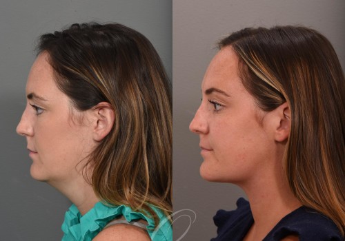 Enhance Your Features With Cleopatra Contour Plastic Surgery